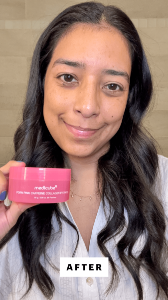 Foresto after applying the Medicube PDRN Caffeine Collagen Eye Patch